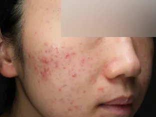 中等症ニキビ①