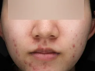 中等症ニキビ②