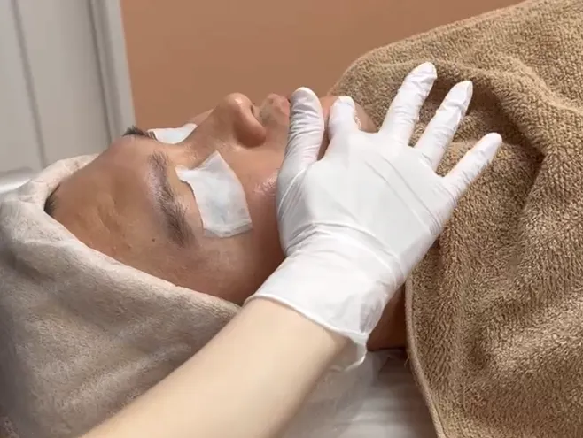 ケミカルピーリング