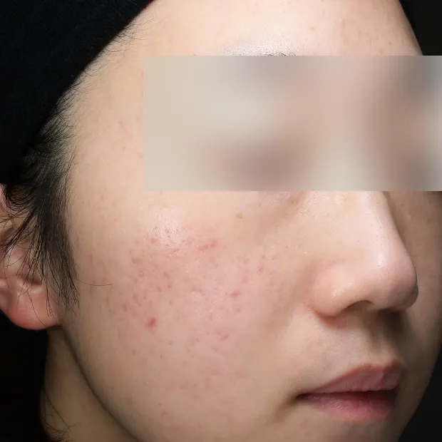 中等症ニキビ①治療のAfter