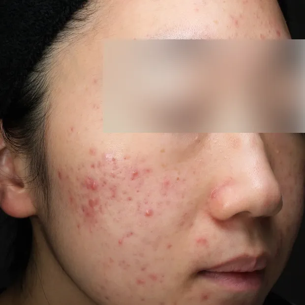 中等症ニキビ①治療のBefore