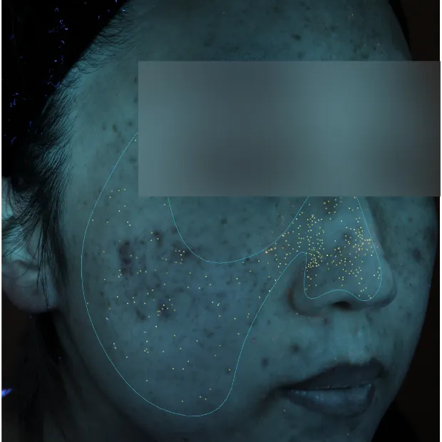 中等症ニキビ①治療のAfter