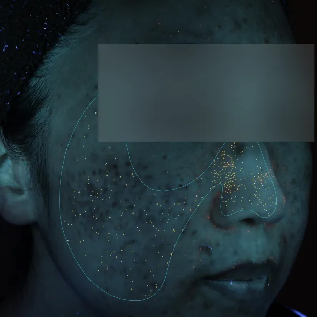 中等症ニキビ①治療のBefore