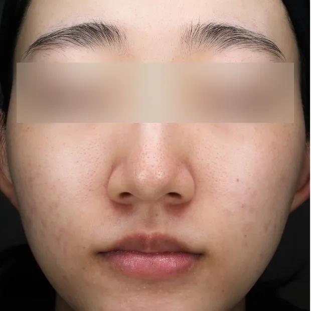 中等症ニキビ②治療のAfter