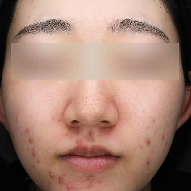 中等症ニキビ②治療のBefore