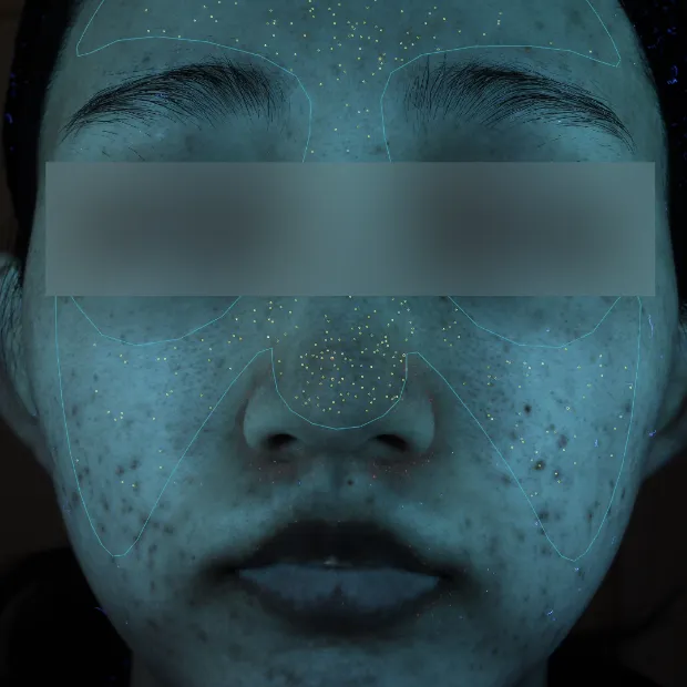 中等症ニキビ②治療のAfter