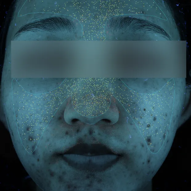 中等症ニキビ②治療のBefore