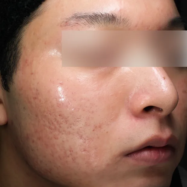 ニキビ跡治療のAfter