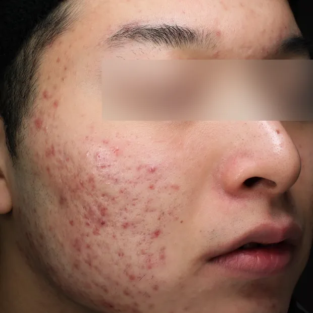 ニキビ跡治療のBefore