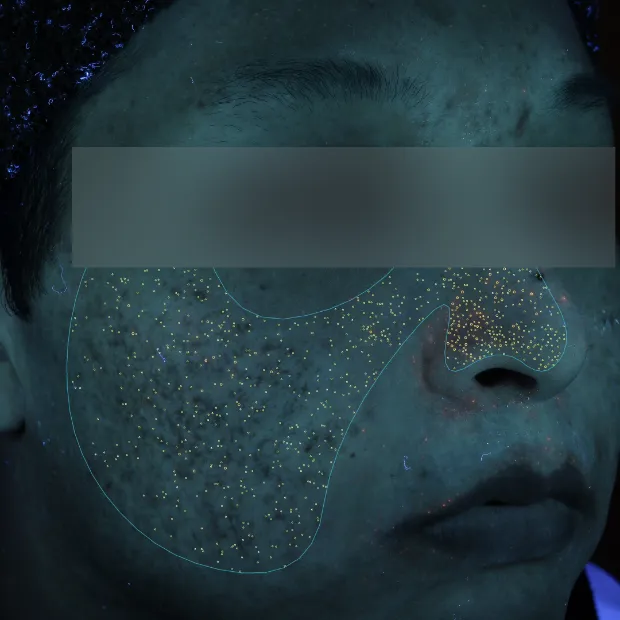 ニキビ跡治療のAfter