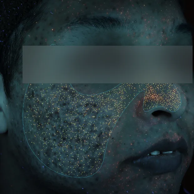 ニキビ跡治療のBefore