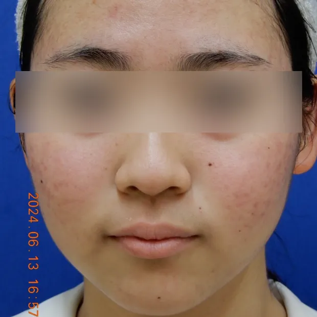 重症ニキビ治療のAfter