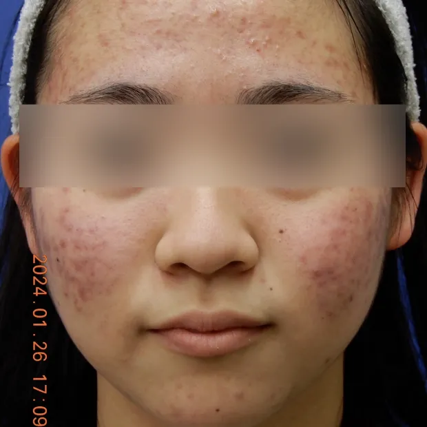 重症ニキビ治療のBefore
