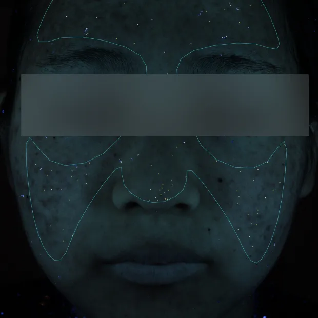 重症ニキビ治療のAfter