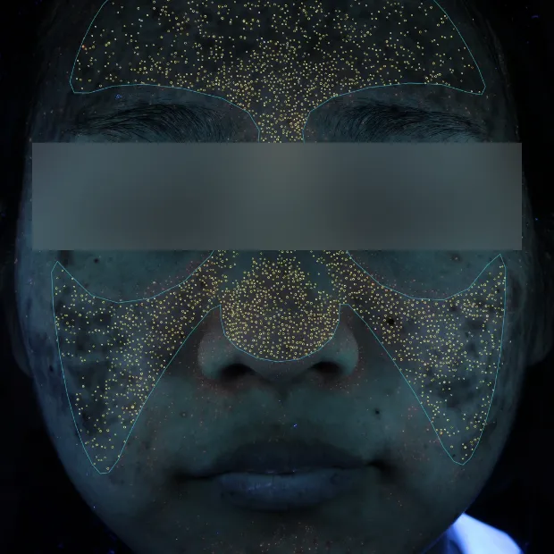 重症ニキビ治療のBefore