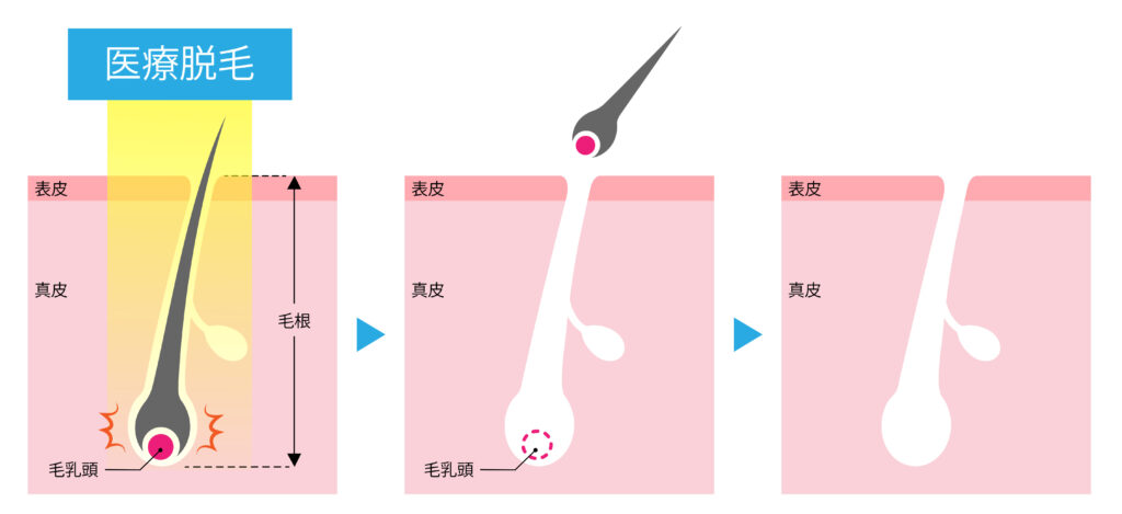 永久脱毛は医療レーザーでしかできません。