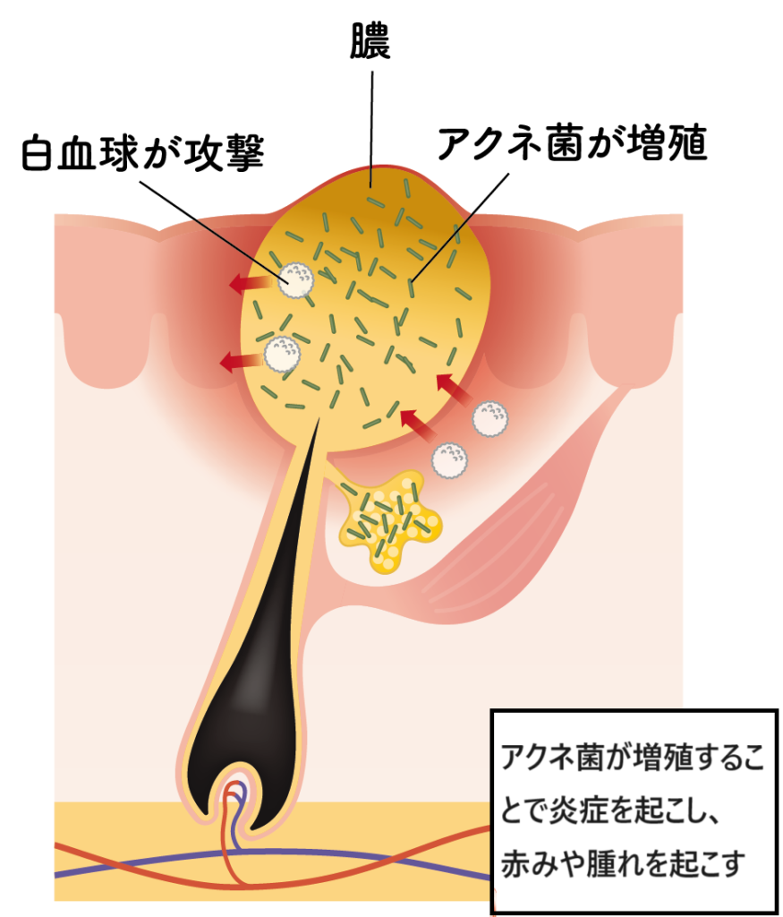 重篤化なニキビ