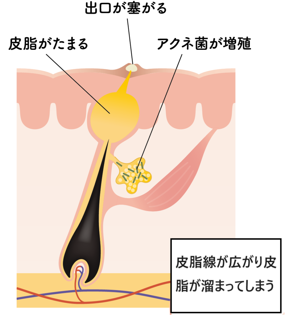 ニキビが重篤化する理由