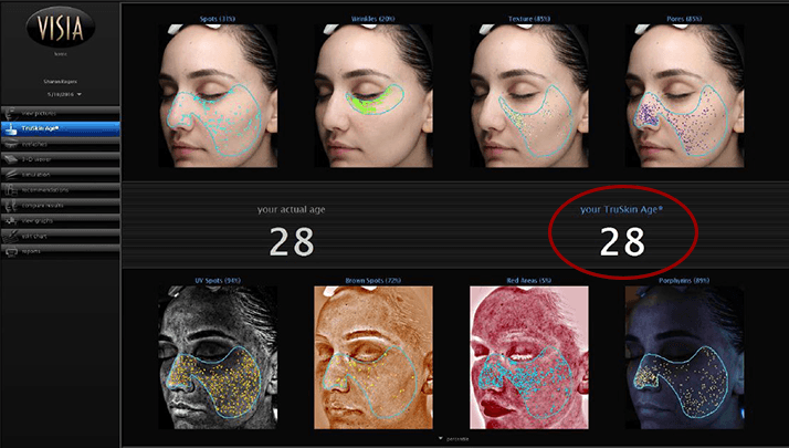 最新肌診断機「VISIA」を使用して治療プランを決定！