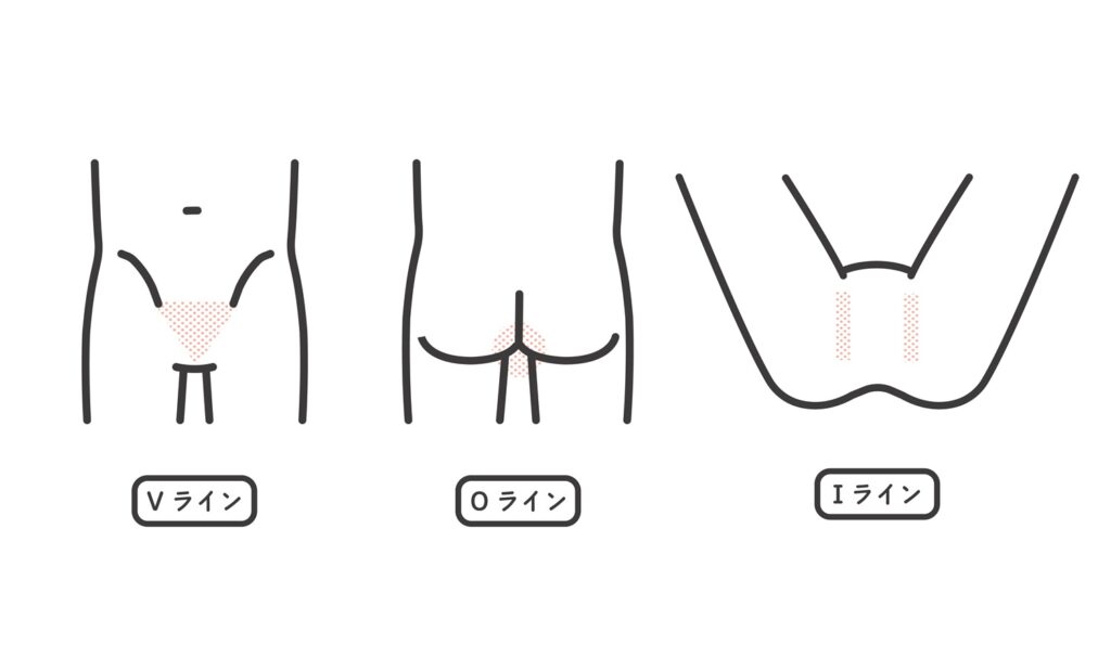 VIO脱毛の施術範囲 - Vライン・Iライン・Oライン