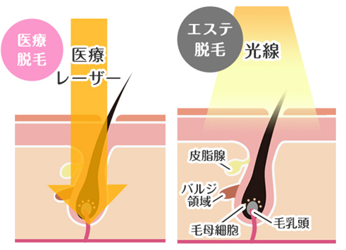 髭脱毛のカラクリとは？